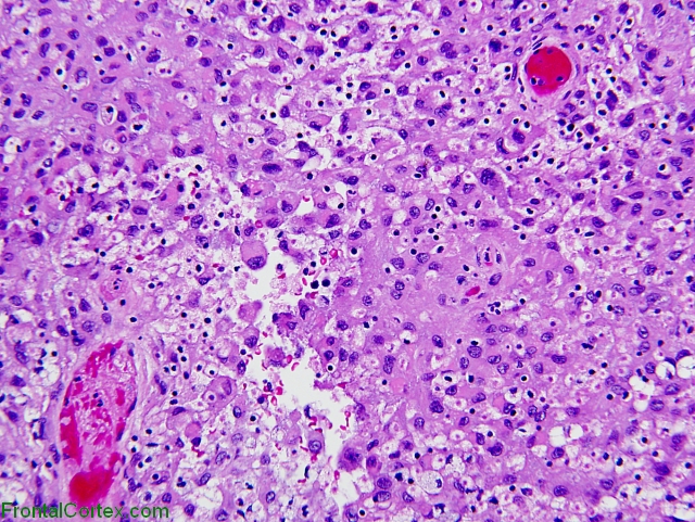 Rhabdoid meningioma, H&E stain x200